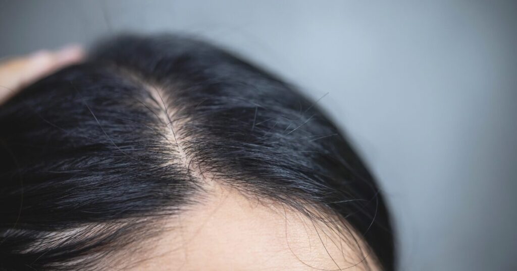 50代女性　薄毛
